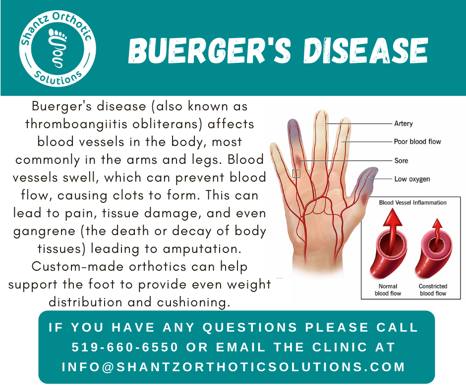 Buerger’s Disease